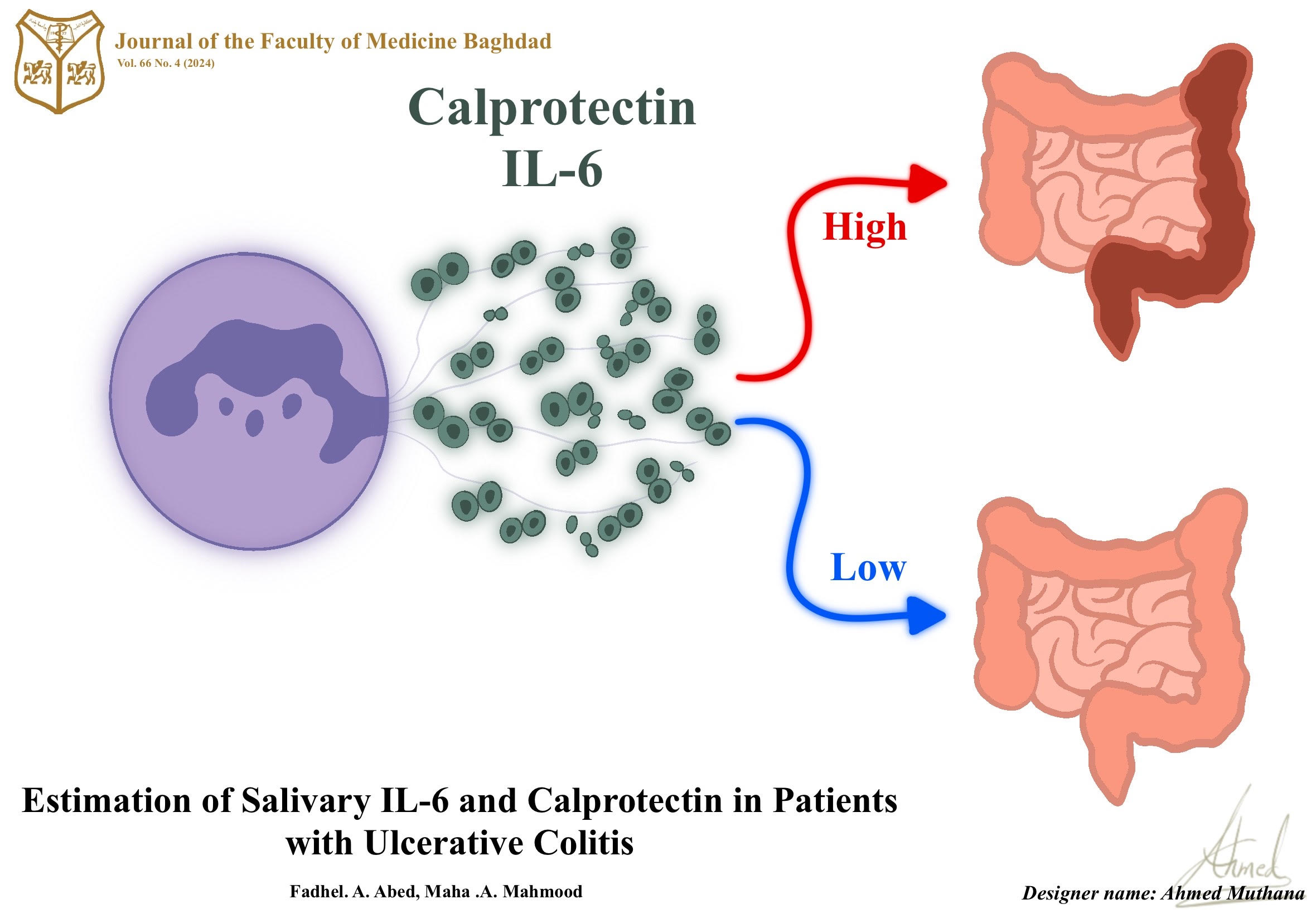 Calprotectin, IL-6, Salivary, Ulcerative colitis patient